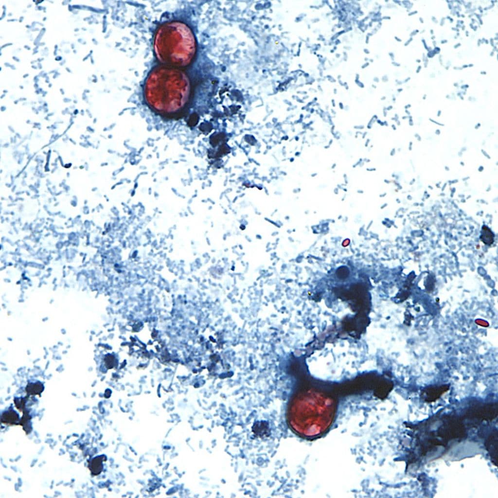 US parasite outbreak raises food safety concerns