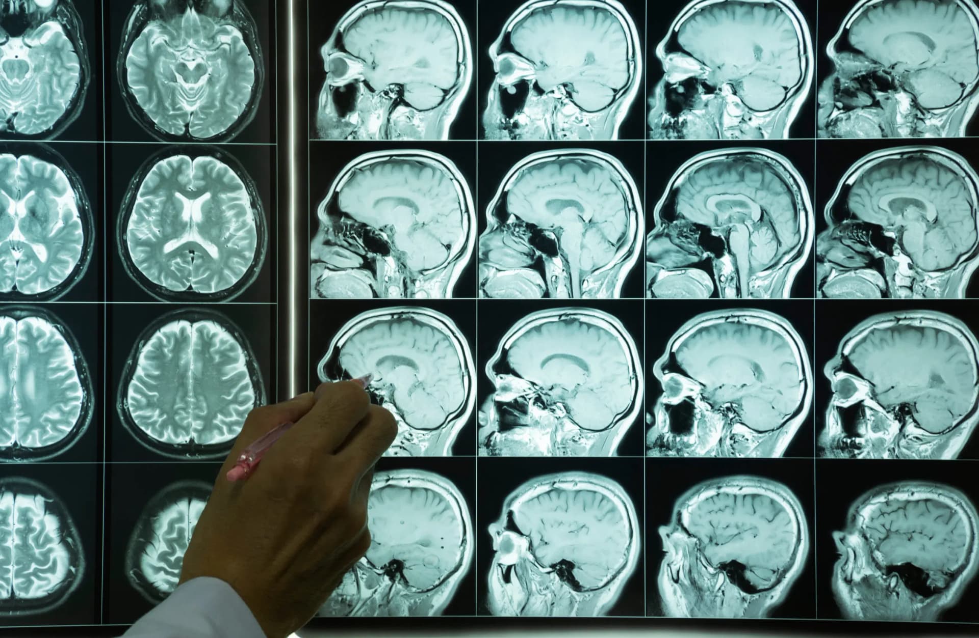 Guyana among hardest-hit in the Americas for brain disorders