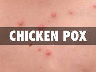Trinidad reporting several suspected cases of chickenpox
