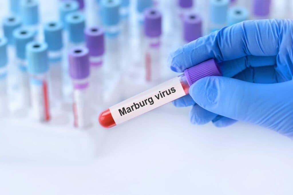 Marburg virus detected in Uganda toddler
