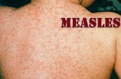 Measles outbreak kills more than 500 children in Bangladesh